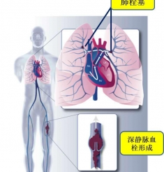 血栓防治专业组简介