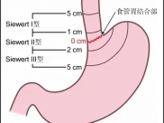 【山肿特色医疗技术】胸腹腔镜联合经右胸上腹食管胃结合部癌（贲门癌）切除、食管胃overlap吻合术