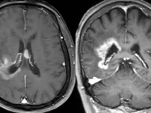 【山肿特色技术】我院神经外科开展专用颅脑手术导航机器人辅助微创脑肿瘤活检术