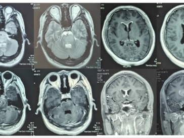 【山肿特色医疗技术】我院神经外科多方案联合成功救治室管膜、软脑膜广泛播散延髓脑干胶质瘤危重患者