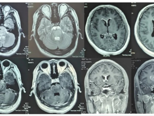【山肿特色医疗技术】我院神经外科多方案联合成功救治室管膜、软脑膜广泛播散延髓脑干胶质瘤危重患者
