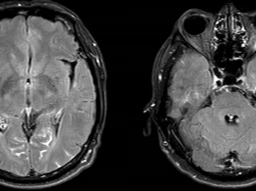 【山肿特色医疗技术】EGFR突变阳性脑膜转移患者治疗新突破