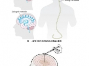 【山肿特色医疗技术】我院神经外科“控压入脑”方案显著改善难治性脑膜转移瘤（LMs）患者预后