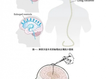 【山肿特色医疗技术】我院神经外科“控压入脑”方案显著改善难治性脑膜转移瘤（LMs）患者预后