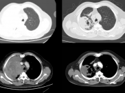【山肿特色医疗技术】绝境逢生！三联疗法破解晚期SMARCA4缺失型肺癌困局