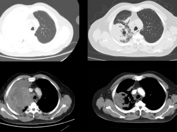 【山肿特色医疗技术】绝境逢生！三联疗法破解晚期SMARCA4缺失型肺癌困局