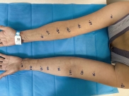 【山肿特色医疗技术】乳腺外科二病区成功开展淋巴管-静脉吻合术攻克乳腺癌术后淋巴水肿难题