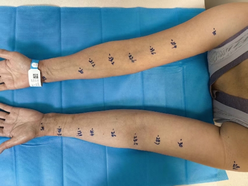 【山肿特色医疗技术】乳腺外科二病区成功开展淋巴管-静脉吻合术攻克乳腺癌术后淋巴水肿难题