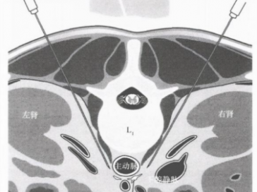 【山肿特色医疗技术】精准断痛-腹腔神经丛毁损术助力胰腺癌晚期癌痛患者重获安宁生活
