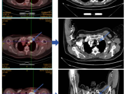 【山肿特色医疗技术】联合疗法再创佳绩——高龄SMARCA4缺失肺癌患者获良效