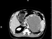 【山肿特色医疗技术】精准攻坚妙手除瘤｜山肿肝胆外科成功完成2例腹膜后巨大肿瘤切除